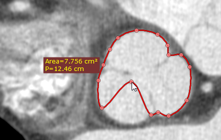 Radiant-Dicom-Viewer-Closed-Polygon-Edit-Node