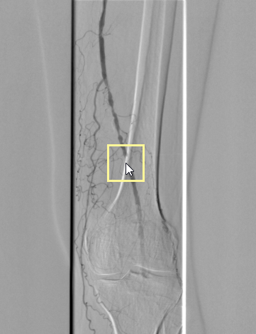 Radiant-Dicom-Viewer-DSA-Mask-Auto-Pixel-Shift-Misaligned