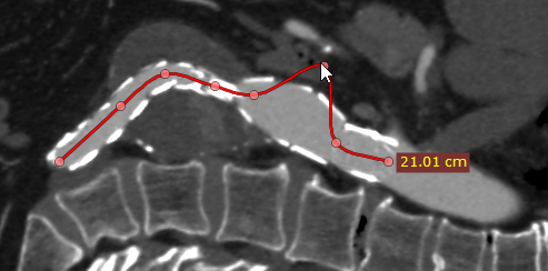 Radiant-Dicom-Viewer-Open-Polygon-Edit-Node