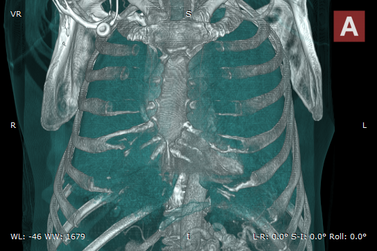 RadiAnt_DICOM_Viewer_3D_Volume_Rendering_3DPresets_BonesAndSkin1