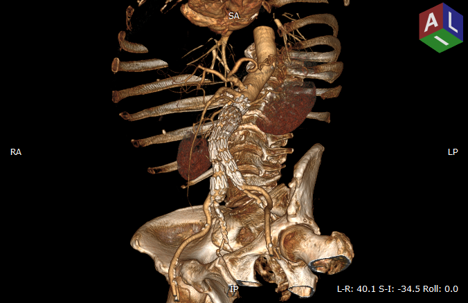 RadiAnt_DICOM_Viewer_3D_Volume_Rendering_3DRotation