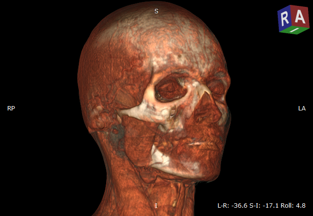 RadiAnt_DICOM_Viewer_3D_Volume_Rendering_Example