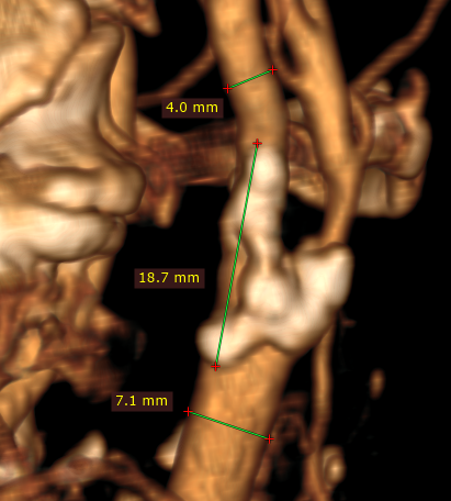 RadiAnt_DICOM_Viewer_3D_Volume_Rendering_LengthMeasurement