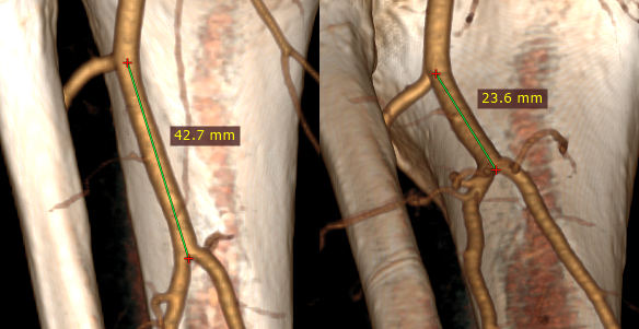 RadiAnt_DICOM_Viewer_3D_Volume_Rendering_LengthMeasurementCaveats2