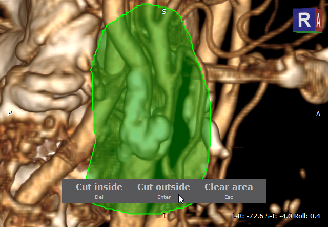 RadiAnt_DICOM_Viewer_3D_Volume_Rendering_ScalpelExample1