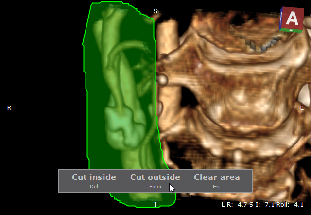 RadiAnt_DICOM_Viewer_3D_Volume_Rendering_ScalpelExample2