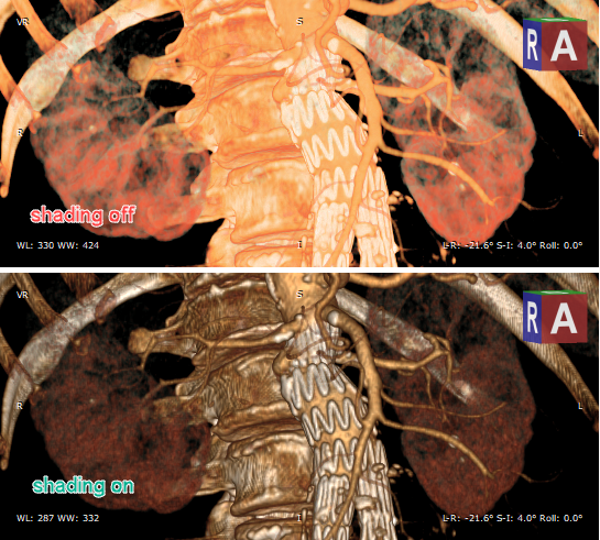 RadiAnt_DICOM_Viewer_3D_Volume_Rendering_ShadingDemo