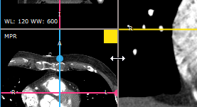 RadiAnt_DICOM_Viewer_3DMPR_BorderDrag