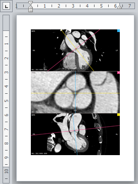 RadiAnt_DICOM_Viewer_3DMPR_PasteIntoWord