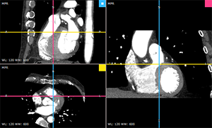 RadiAnt_DICOM_Viewer_3DMPR_ViewportLayoutCols21