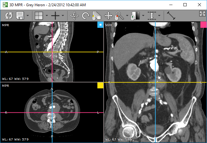 RadiAnt_DICOM_Viewer_3DMPR_Window