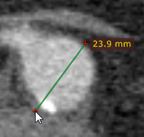 RadiAnt_DICOM_Viewer_Adjust_Measurements_Length