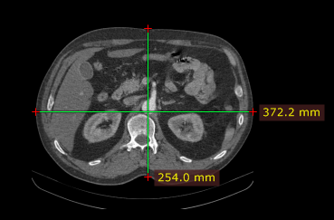 RadiAnt_DICOM_Viewer_Adjust_Measurements_Length_Horizontal_Vertical