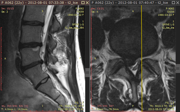 RadiAnt_DICOM_Viewer_Annotations_Cross_Reference_Lines_2