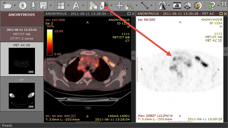 RadiAnt_DICOM_Viewer_Image_Fusion_PET_CT_Adjusting_Scale