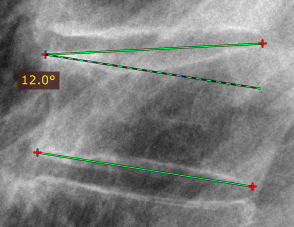 RadiAnt_DICOM_Viewer_Measurements_Cobb_Angle