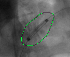 RadiAnt_DICOM_Viewer_Measurements_Pencil