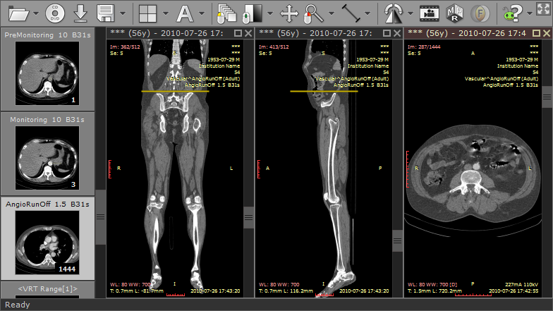 RadiAnt_DICOM_Viewer_MPR_Coronal_Sagittal_Axial_Planes