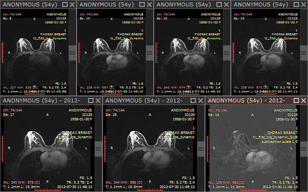 RadiAnt_DICOM_Viewer_Time_Intensity_Curves_Opened_Series