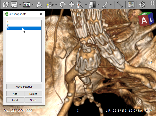 RadiAnt-DICOM-Viewer-3D-Snapshots-Toolwindow