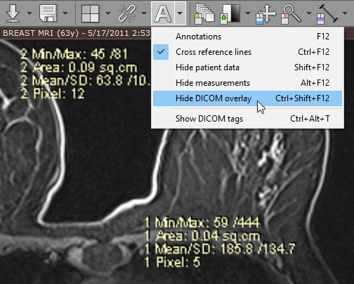 RadiAnt-DICOM-Viewer-DICOM-Overlay-Disable-Menu