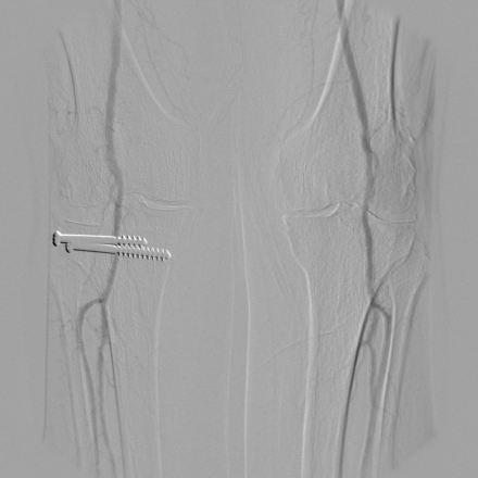 Radiant-Dicom-Viewer-DSA-Lower-Limbs-Uncorrected