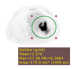 Radiant-Dicom-Viewer-Ellipse-SUV-Sample