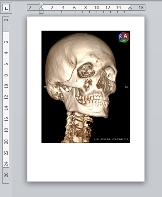 RadiAnt_DICOM_Viewer_3D_Volume_Rendering_PasteFromClipboard