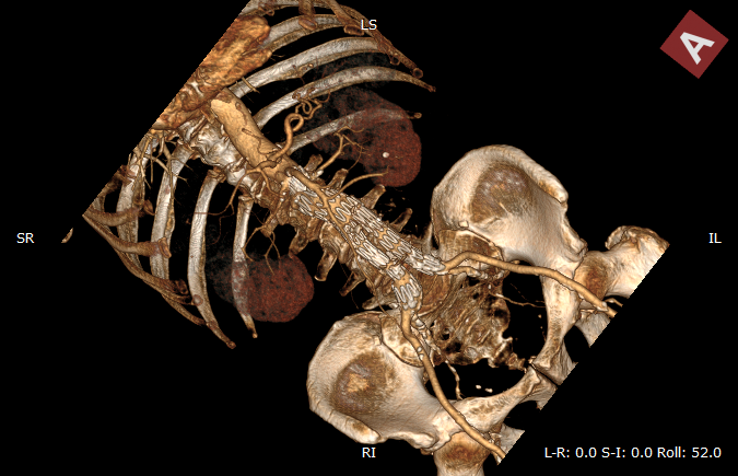 RadiAnt_DICOM_Viewer_3D_Volume_Rendering_Roll