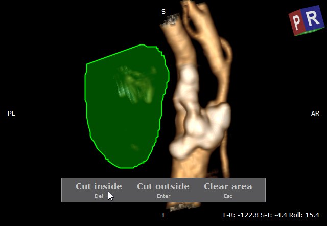 RadiAnt_DICOM_Viewer_3D_Volume_Rendering_ScalpelExample3