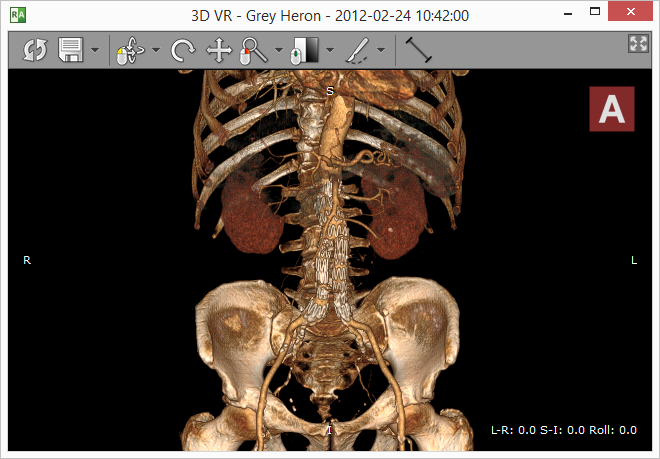 RadiAnt_DICOM_Viewer_3D_Volume_Rendering_Window