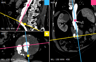 RadiAnt_DICOM_Viewer_3DMPR_LocationMarkers