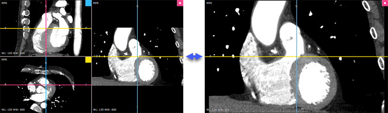 RadiAnt_DICOM_Viewer_3DMPR_MaximizeViewport