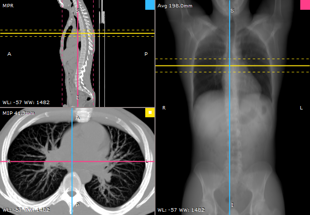 RadiAnt_DICOM_Viewer_3DMPR_Sample_Lungs