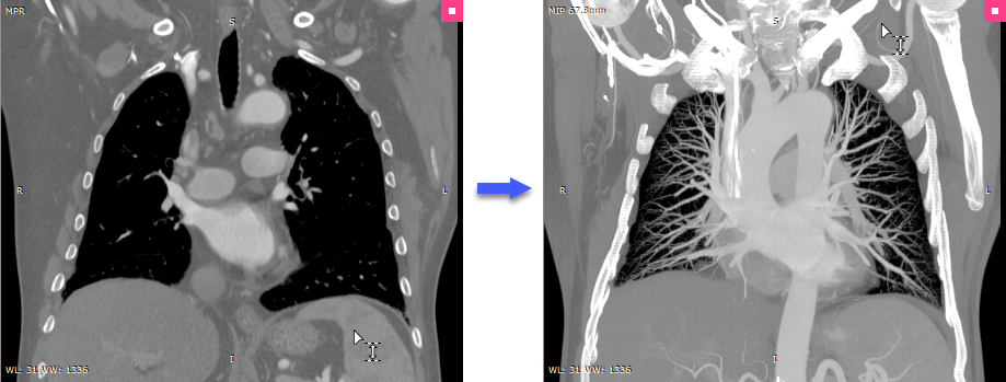 RadiAnt_DICOM_Viewer_3DMPR_ThicknessChange