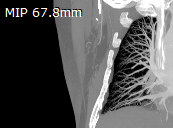 RadiAnt_DICOM_Viewer_3DMPR_ThicknessValue