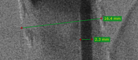 RadiAnt_DICOM_Viewer_Manual_Calibration_Sample