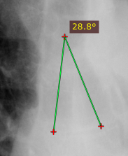 RadiAnt_DICOM_Viewer_Measurements_Angle