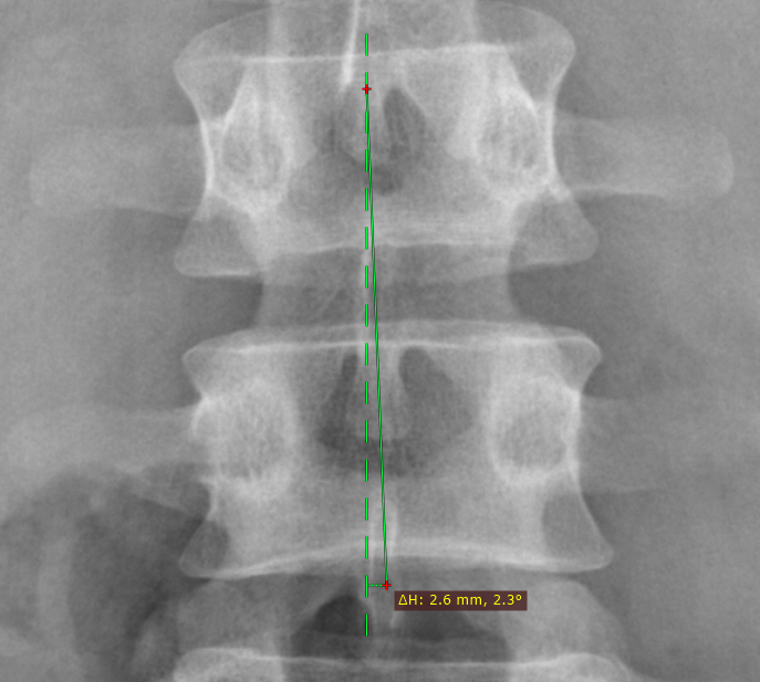 RadiAnt_DICOM_Viewer_Measurements_Deviation_Horizontal