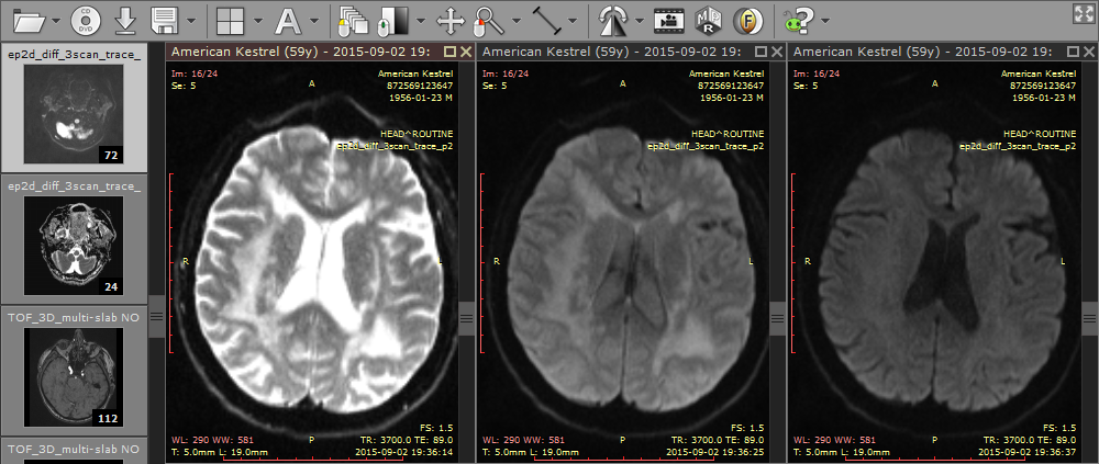 A single DWI sequence in each panel.